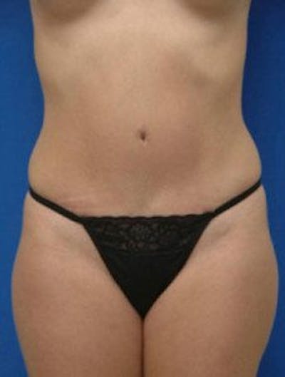 Tummy Tuck Before & After Gallery - Patient 335722 - Image 2