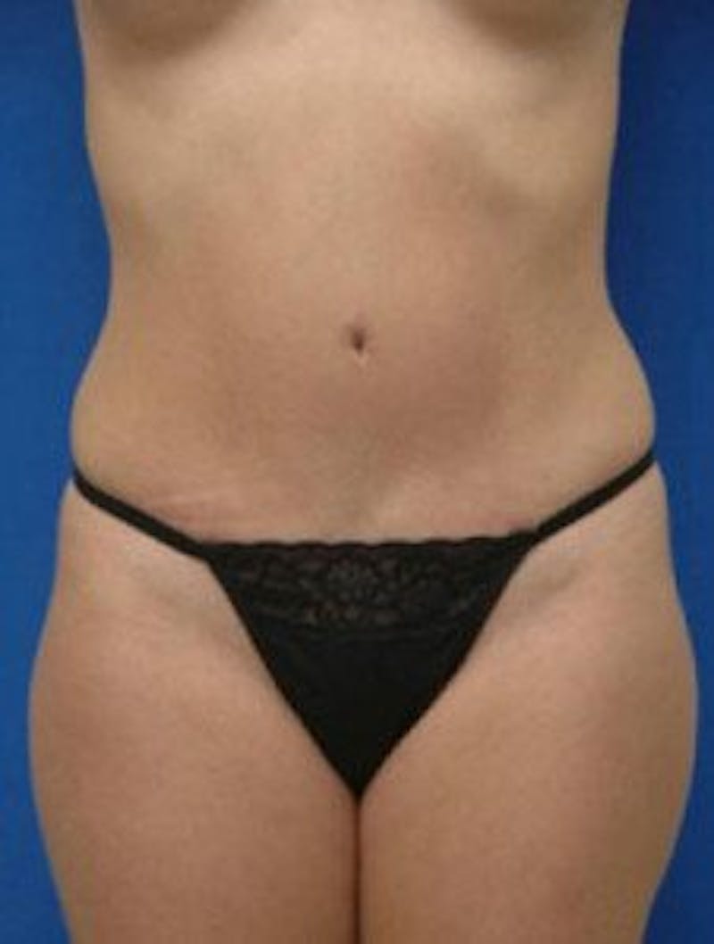 Tummy Tuck Before & After Gallery - Patient 335722 - Image 2