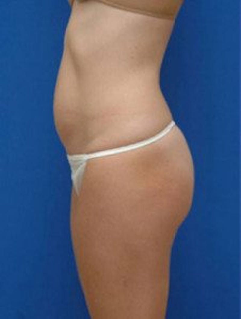 Tummy Tuck Before & After Gallery - Patient 335722 - Image 3