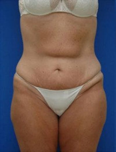 Tummy Tuck Before & After Gallery - Patient 228597 - Image 1