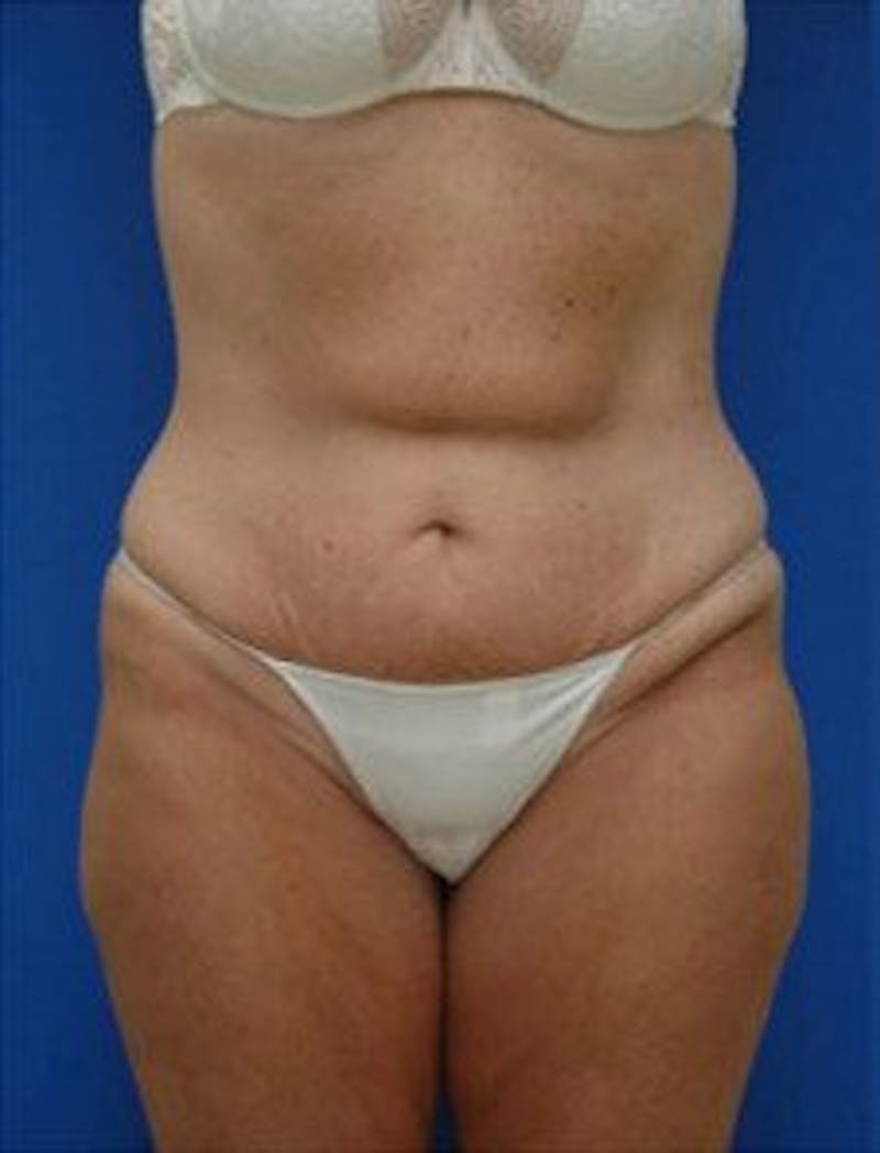 Tummy Tuck Before & After Gallery - Patient 228597 - Image 1