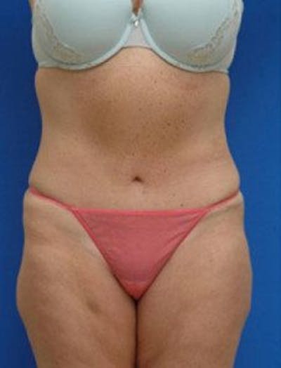 Tummy Tuck Before & After Gallery - Patient 228597 - Image 2