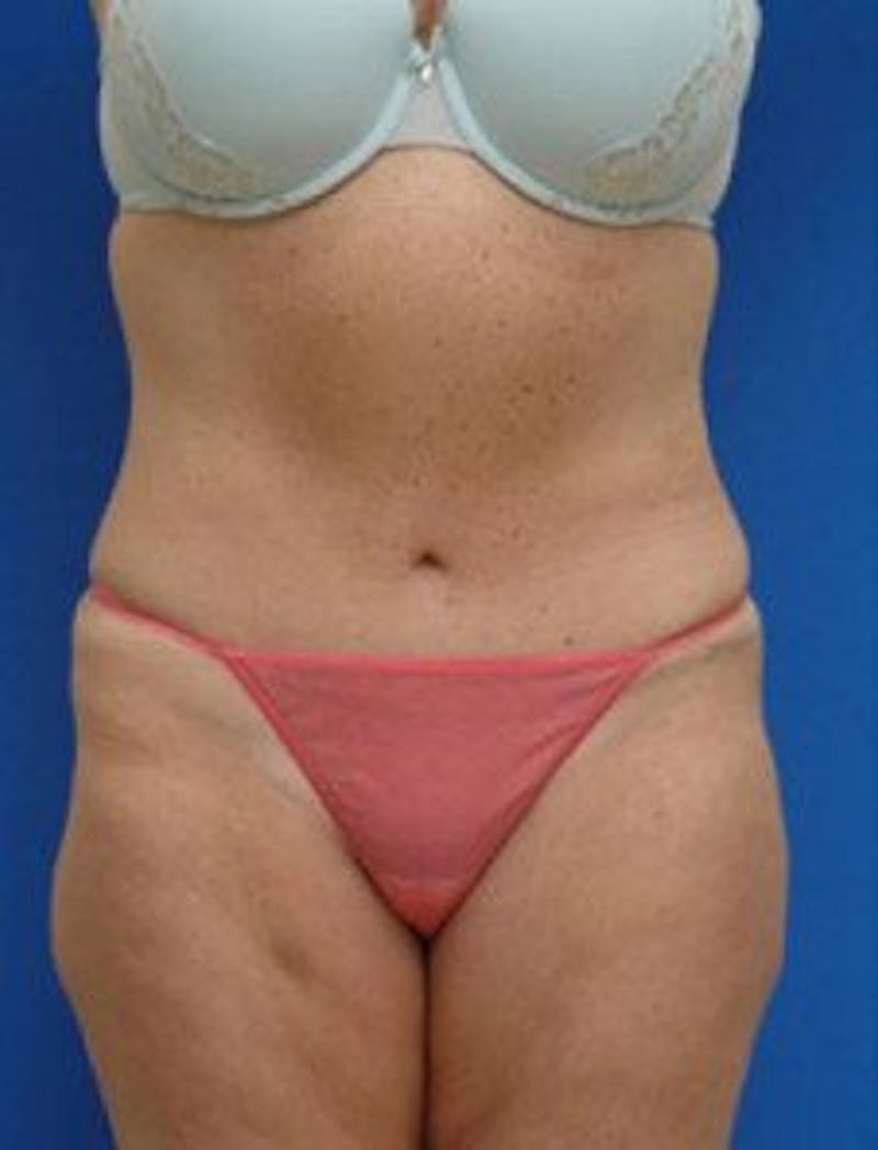 Tummy Tuck Before & After Gallery - Patient 228597 - Image 2