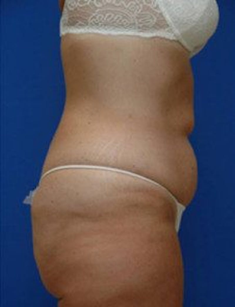 Tummy Tuck Before & After Gallery - Patient 228597 - Image 3