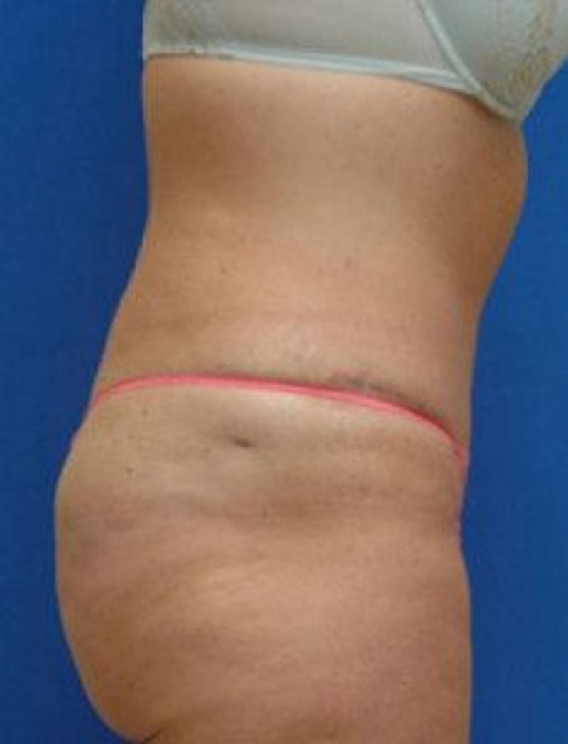 Tummy Tuck Before & After Gallery - Patient 228597 - Image 4