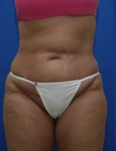 Tummy Tuck Before & After Gallery - Patient 333998 - Image 1