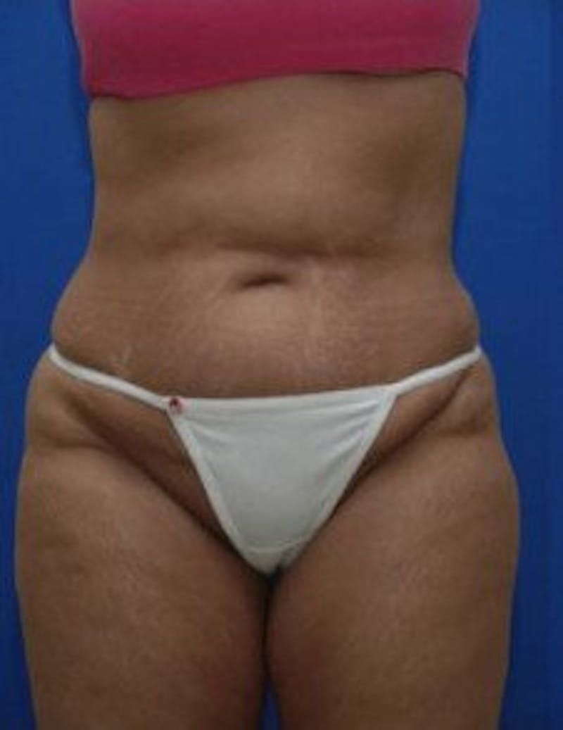 Tummy Tuck Before & After Gallery - Patient 333998 - Image 1