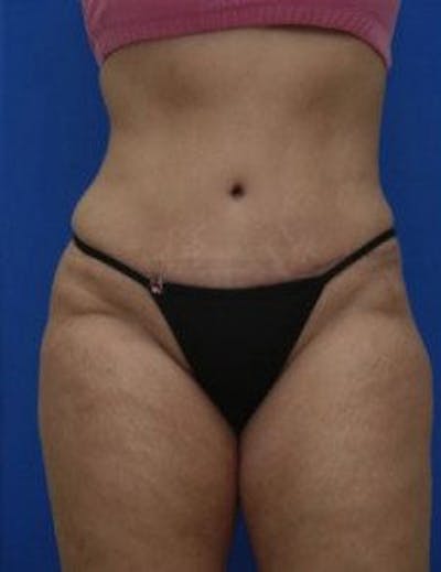 Tummy Tuck Before & After Gallery - Patient 333998 - Image 2