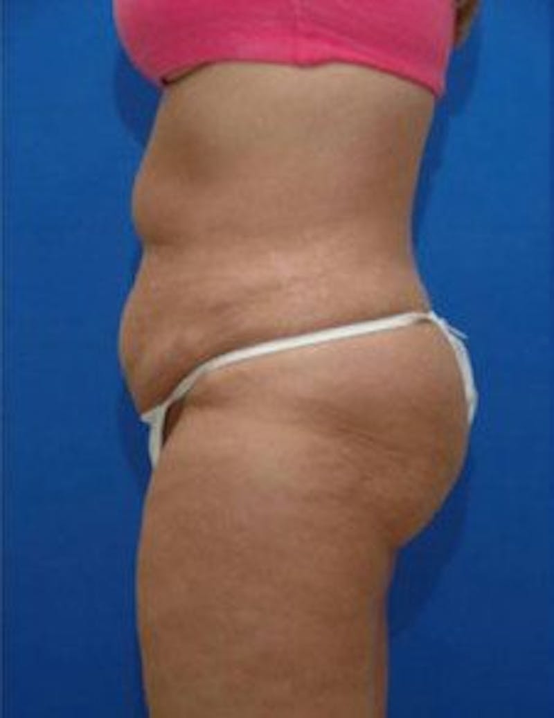 Tummy Tuck Before & After Gallery - Patient 333998 - Image 3