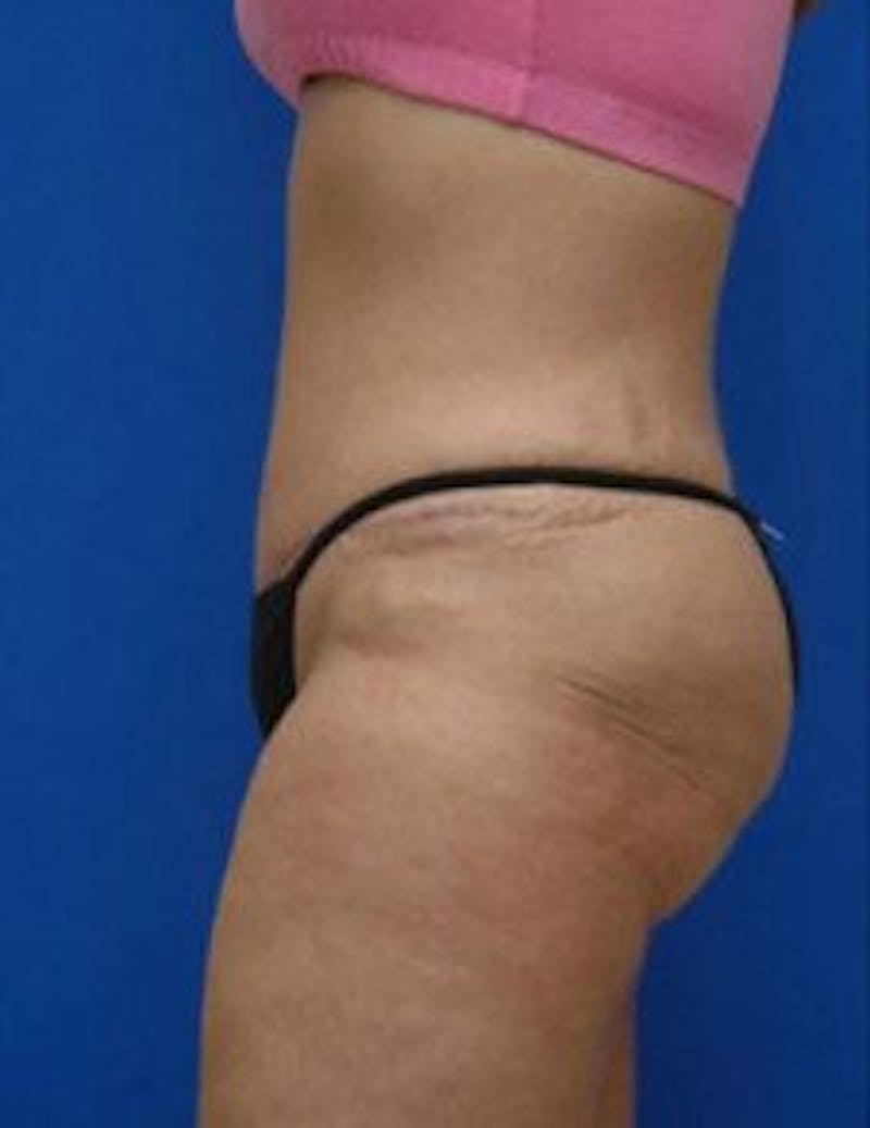 Tummy Tuck Before & After Gallery - Patient 333998 - Image 4