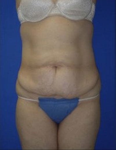 Tummy Tuck Before & After Gallery - Patient 569604 - Image 1