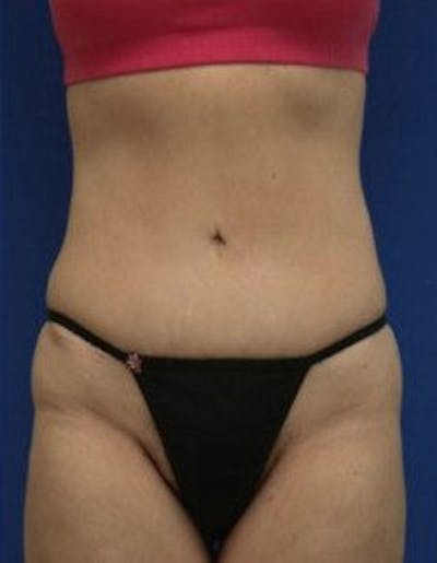 Tummy Tuck Before & After Gallery - Patient 569604 - Image 2