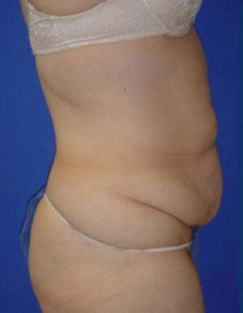Tummy Tuck Before & After Gallery - Patient 569604 - Image 3