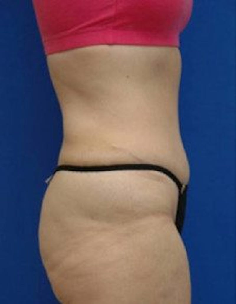 Tummy Tuck Before & After Gallery - Patient 569604 - Image 4