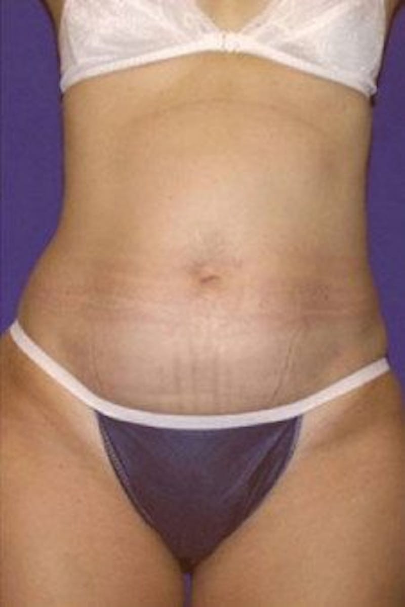 Tummy Tuck Before & After Gallery - Patient 106690 - Image 1
