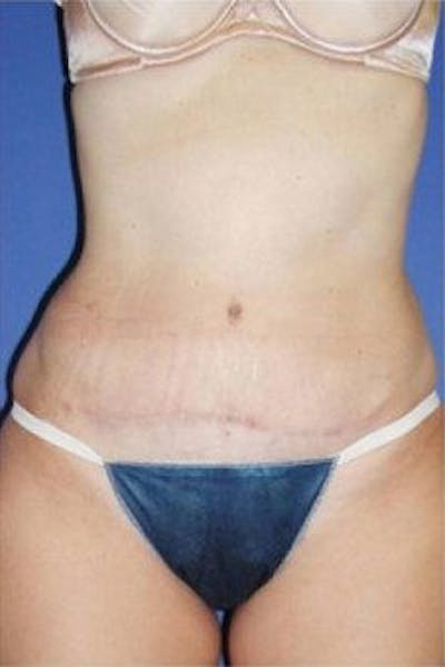 Tummy Tuck Before & After Gallery - Patient 106690 - Image 2