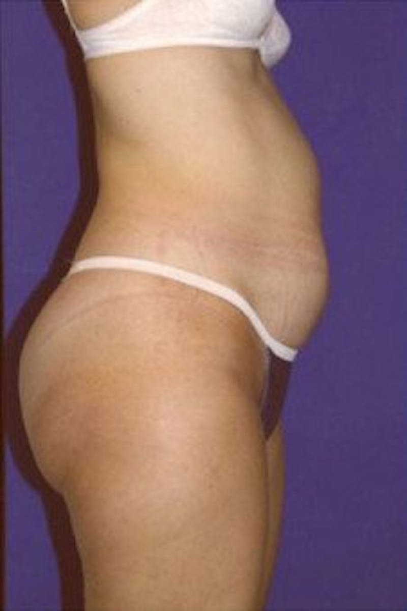 Tummy Tuck Before & After Gallery - Patient 106690 - Image 3