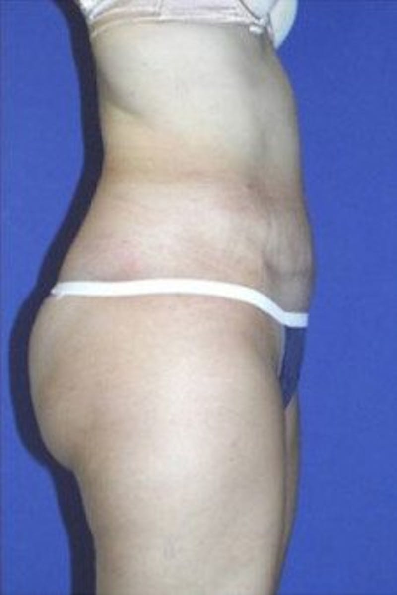 Tummy Tuck Before & After Gallery - Patient 106690 - Image 4