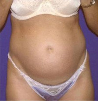 Tummy Tuck Before & After Gallery - Patient 109886 - Image 1
