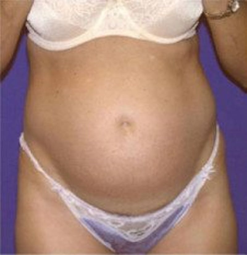 Tummy Tuck Before & After Gallery - Patient 109886 - Image 1