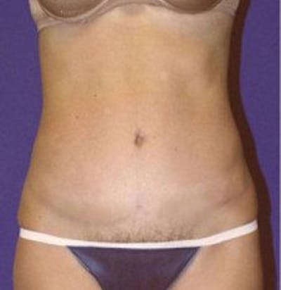 Tummy Tuck Before & After Gallery - Patient 109886 - Image 2