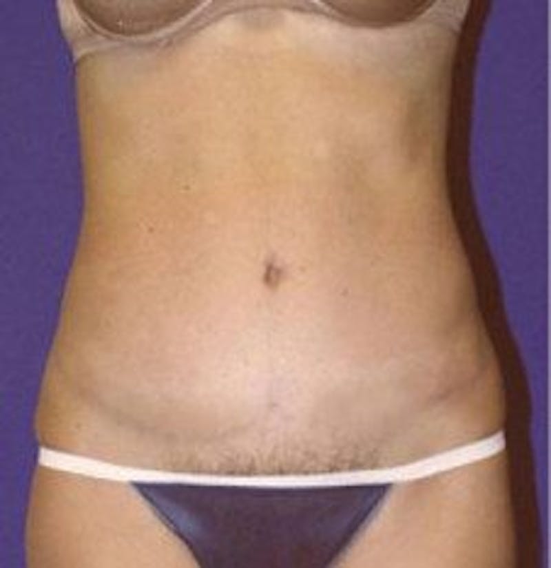 Tummy Tuck Before & After Gallery - Patient 109886 - Image 2