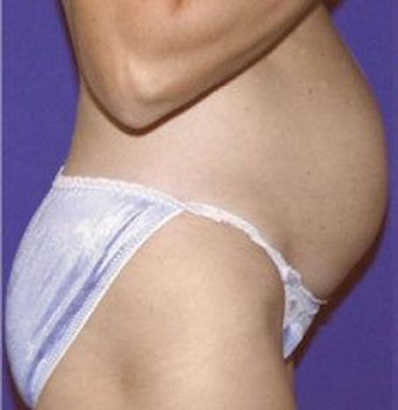 Tummy Tuck Before & After Gallery - Patient 109886 - Image 3