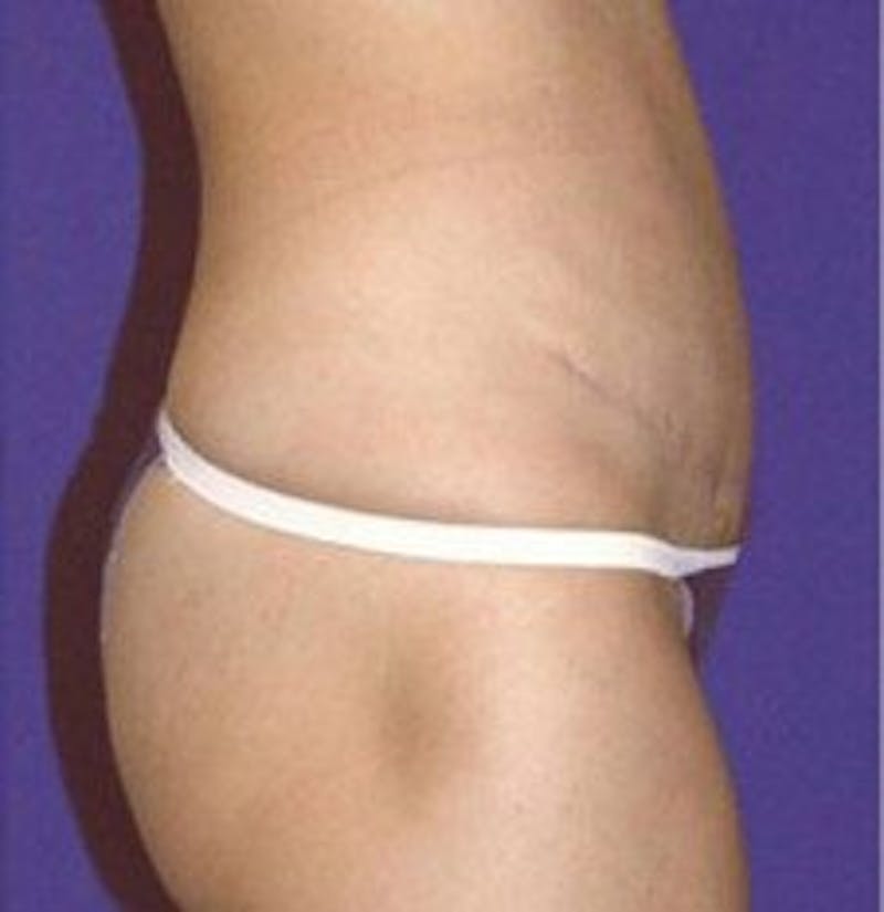 Tummy Tuck Before & After Gallery - Patient 109886 - Image 4