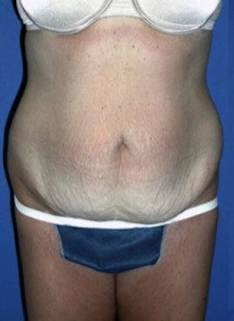 Tummy Tuck Before & After Gallery - Patient 402894 - Image 1