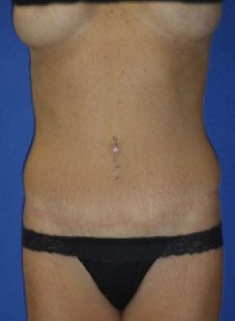 Tummy Tuck Before & After Gallery - Patient 402894 - Image 2