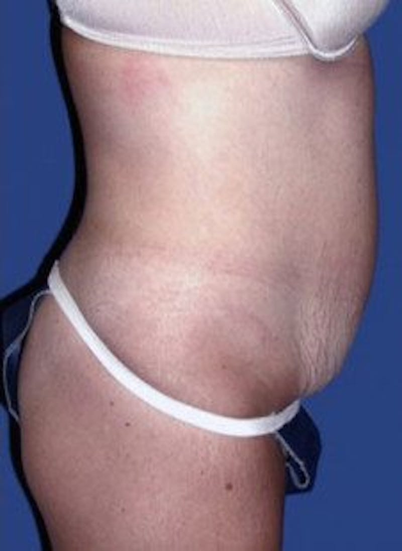 Tummy Tuck Before & After Gallery - Patient 402894 - Image 3