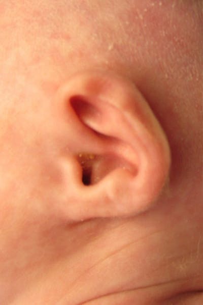 Infant Ear Repair Before & After Gallery - Patient 387786 - Image 1