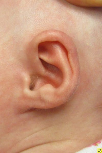Infant Ear Repair Before & After Gallery - Patient 387786 - Image 2