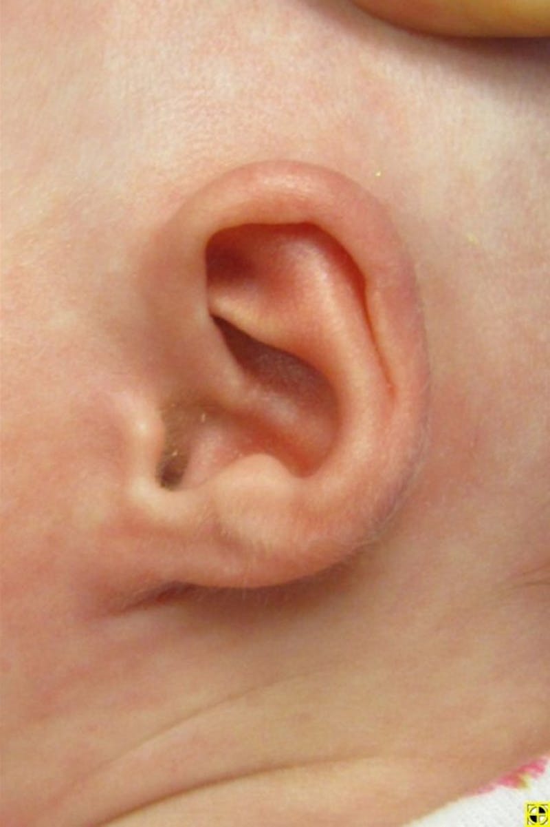 Infant Ear Repair Before & After Gallery - Patient 387786 - Image 2