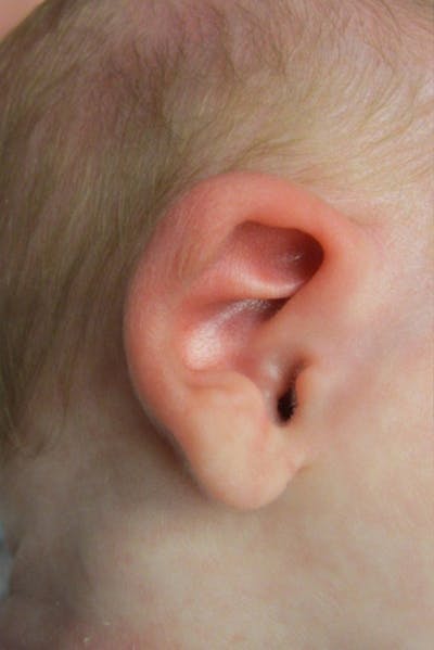 Infant Ear Repair Before & After Gallery - Patient 225182 - Image 1