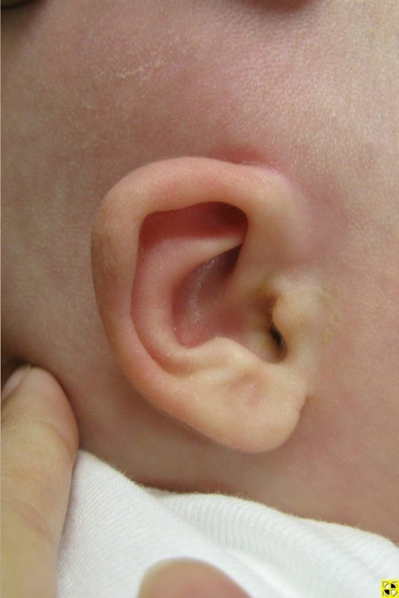 Infant Ear Repair Before & After Gallery - Patient 225182 - Image 2