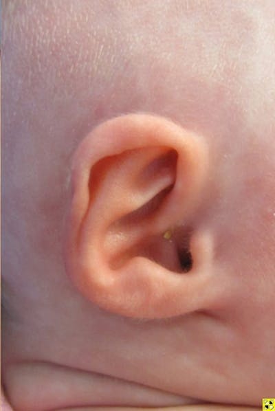 Infant Ear Repair Before & After Gallery - Patient 157711 - Image 1