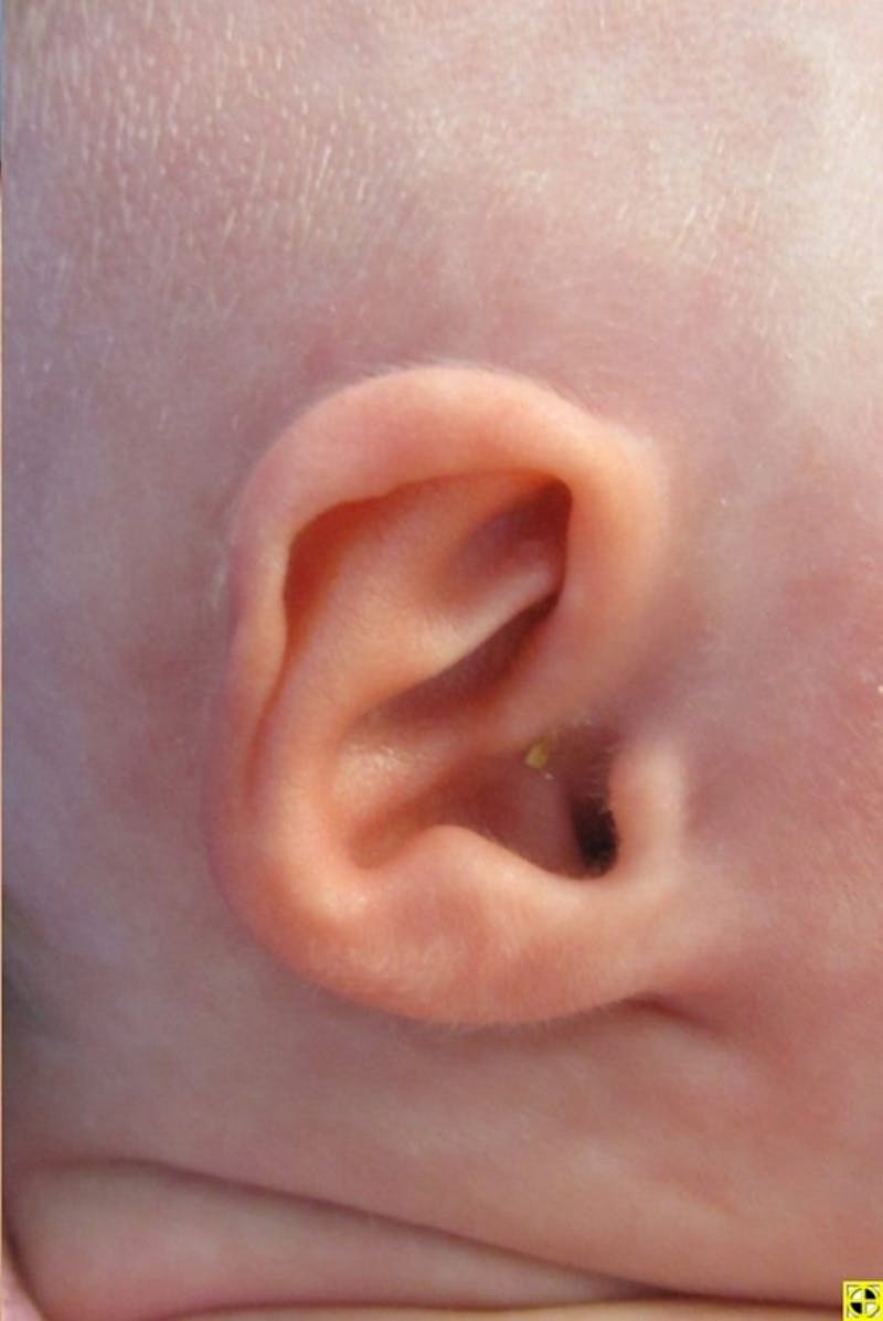 Infant Ear Repair Before & After Gallery - Patient 157711 - Image 1