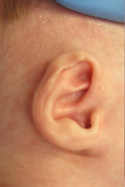 Infant Ear Repair Before & After Gallery - Patient 157711 - Image 2
