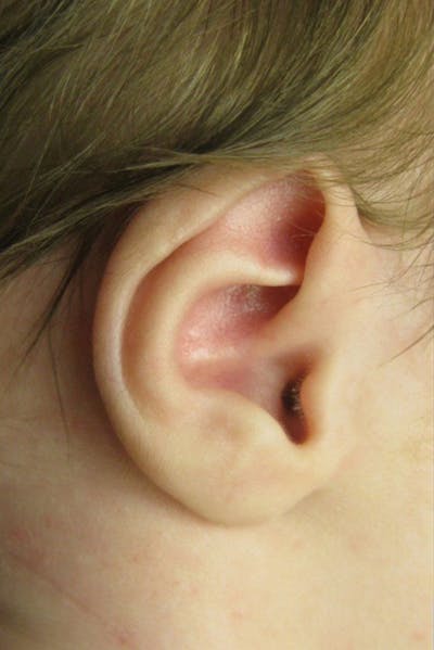 Infant Ear Repair Before & After Gallery - Patient 748976 - Image 1