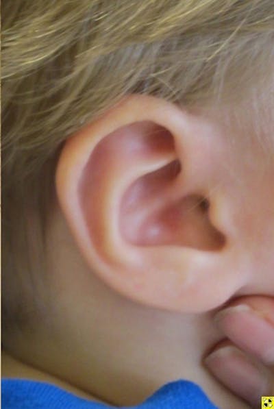 Infant Ear Repair Before & After Gallery - Patient 748976 - Image 2