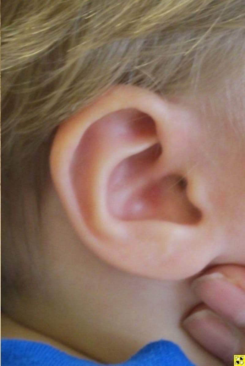 Infant Ear Repair Before & After Gallery - Patient 748976 - Image 2