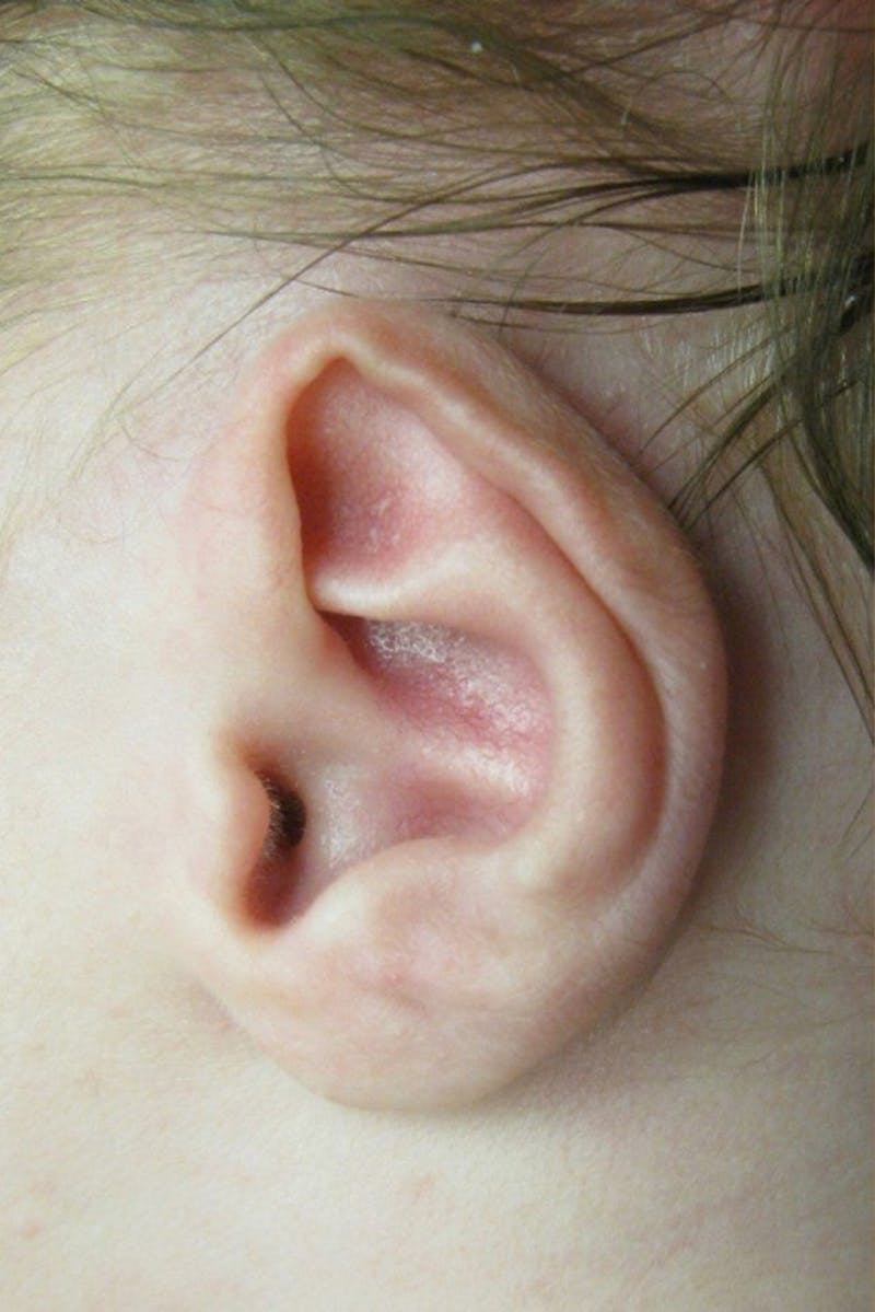 Infant Ear Repair Before & After Gallery - Patient 109645 - Image 1