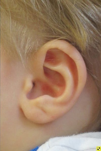 Infant Ear Repair Before & After Gallery - Patient 109645 - Image 2