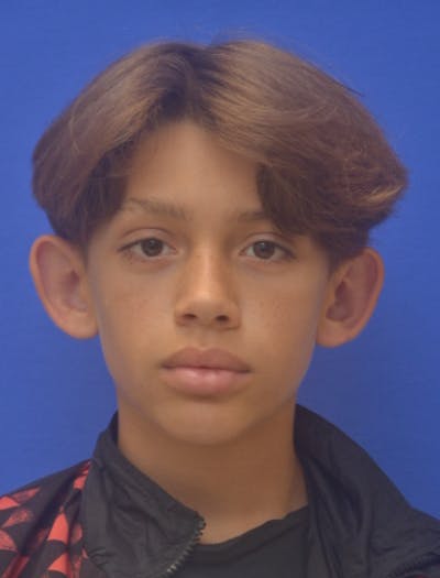 Ear Pinning Surgery Before & After Gallery - Patient 411867 - Image 1