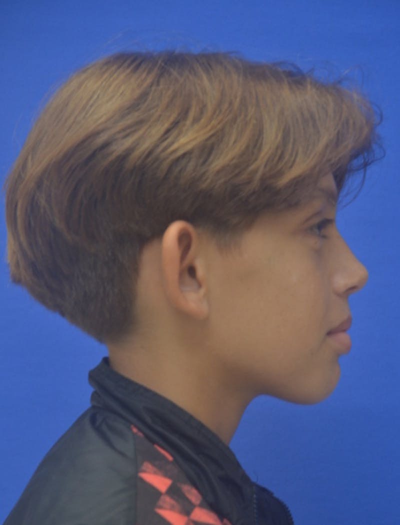 Ear Pinning Surgery Before & After Gallery - Patient 411867 - Image 3