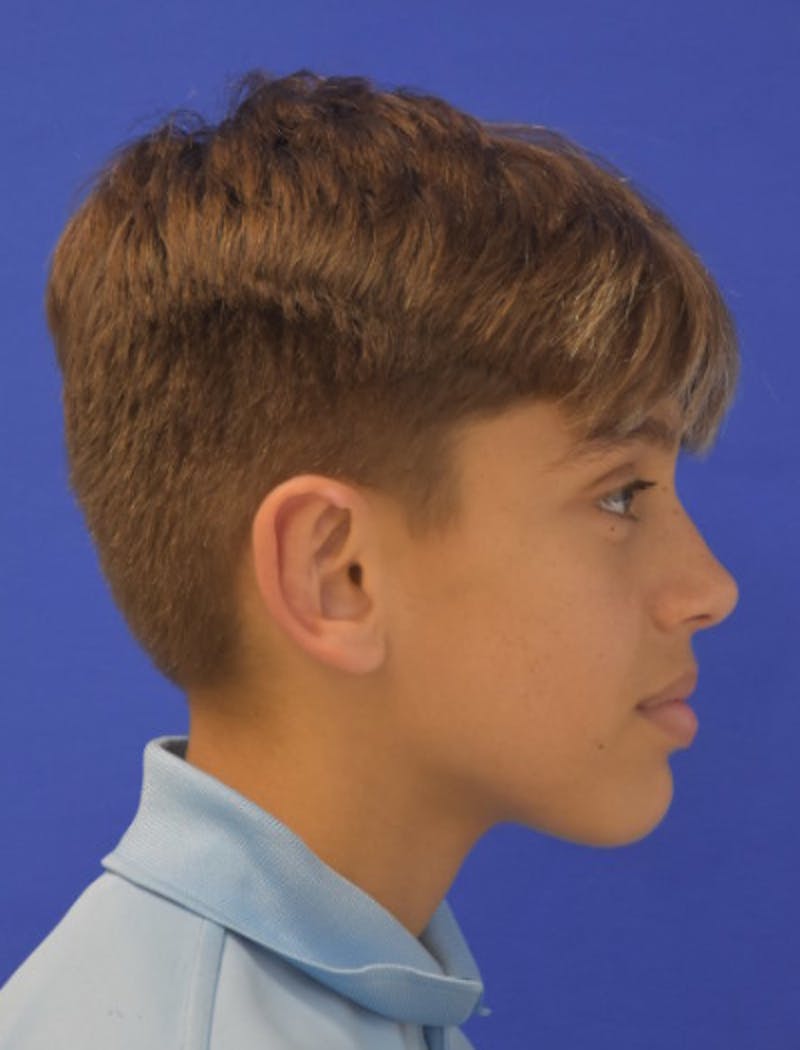 Ear Pinning Surgery Before & After Gallery - Patient 411867 - Image 4