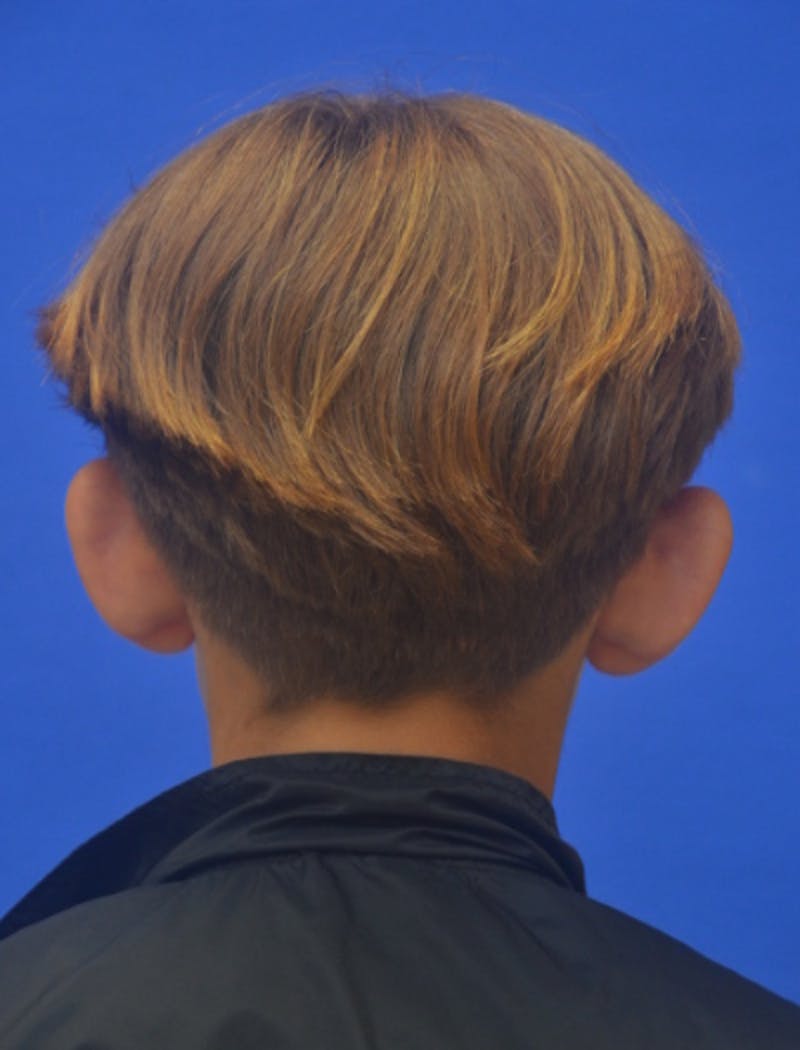 Ear Pinning Surgery Before & After Gallery - Patient 411867 - Image 5