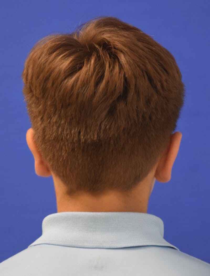 Ear Pinning Surgery Before & After Gallery - Patient 411867 - Image 6