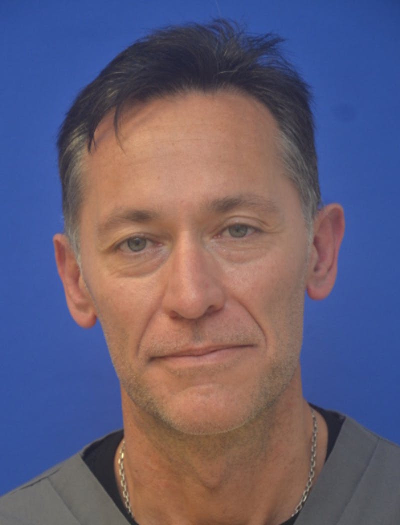 Ear Pinning Surgery Before & After Gallery - Patient 408170 - Image 1